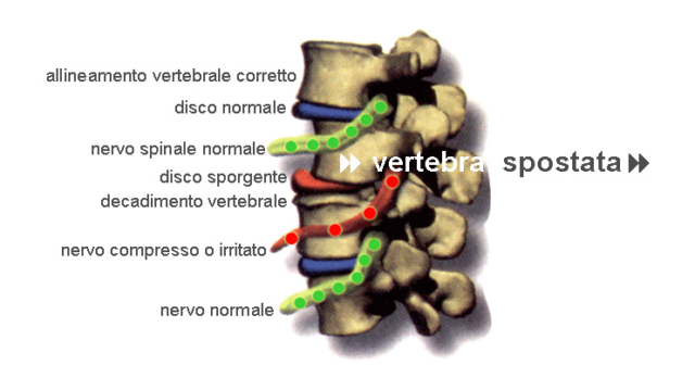 sublussazione vertebrale