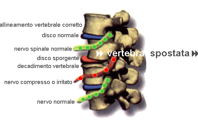 sublussazione vertebrale