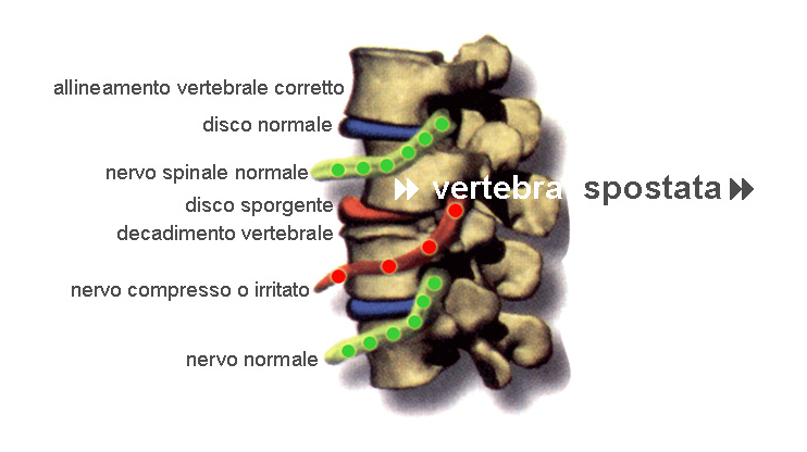 sublussazione vertebrale